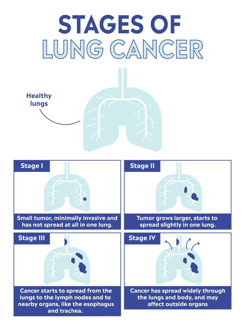 stadii de cancer pulmonar