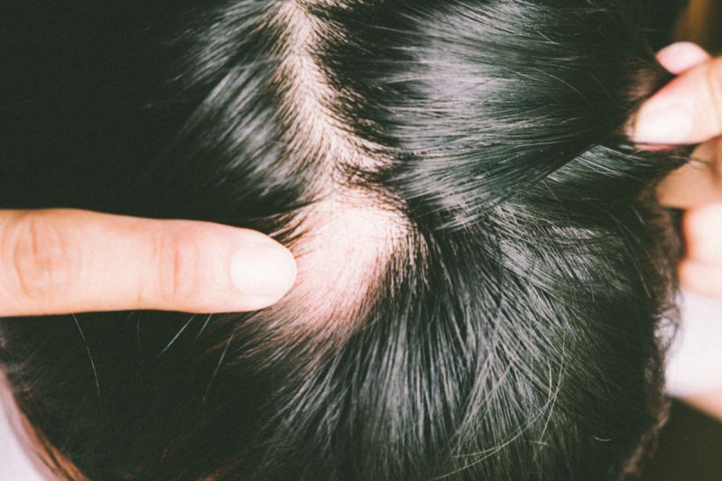 Mann mit Alopecia areata am Kopf, Fleckenkahlheit, Haarausfallproblem