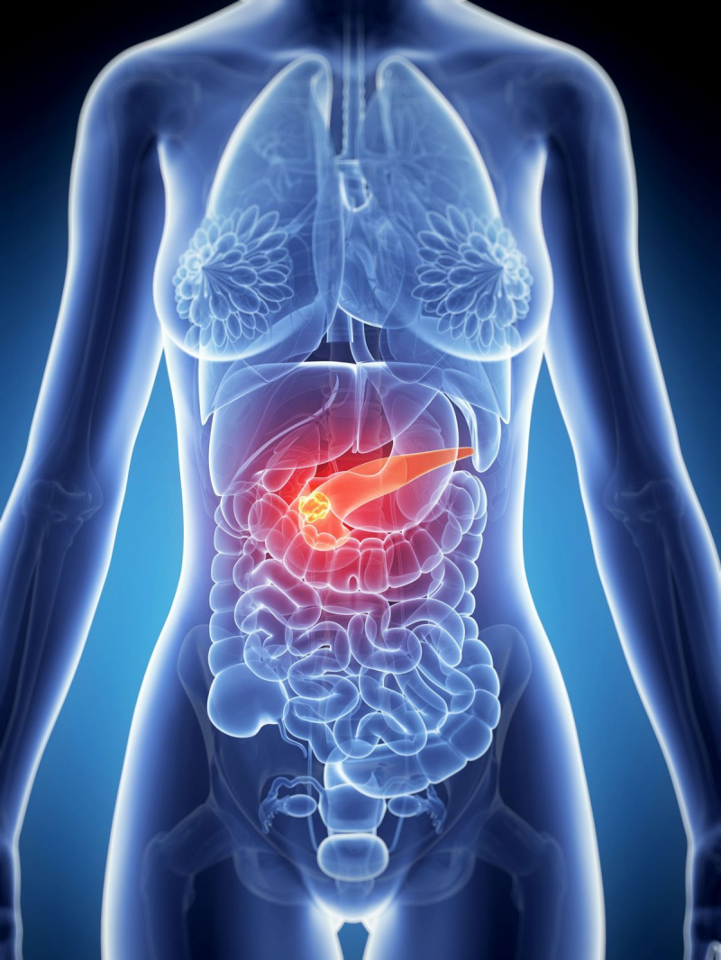tumor de câncer pancreático