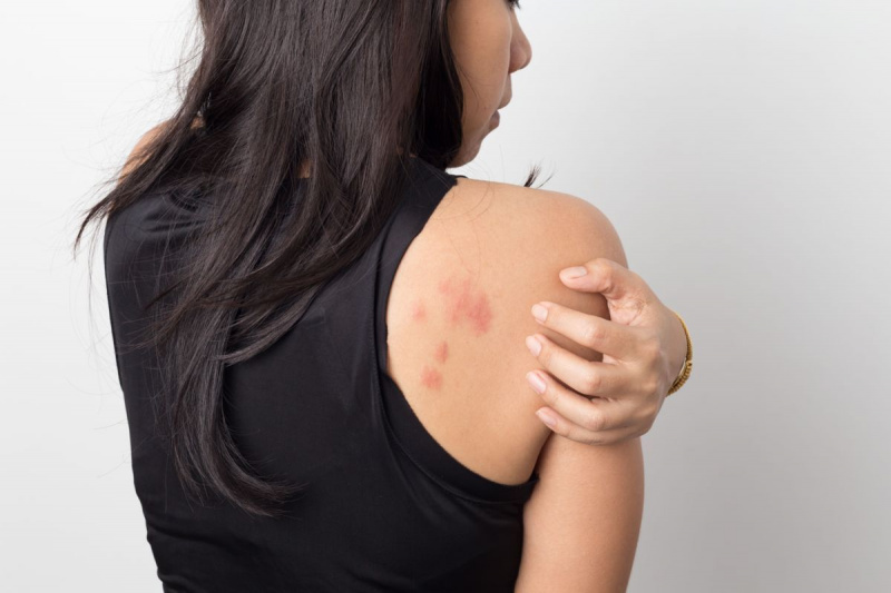 Frau, die ihre Haut hinter Juckreiz zeigt, mit allergischen Hautausschlag-Urtikaria-Symptomen