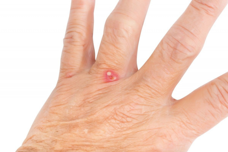 picada de formiga vermelha na mão de uma fêmea adulta sênior perto de seus dedos