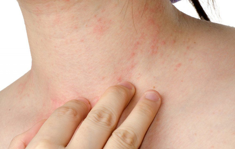 remédios naturais para eczema