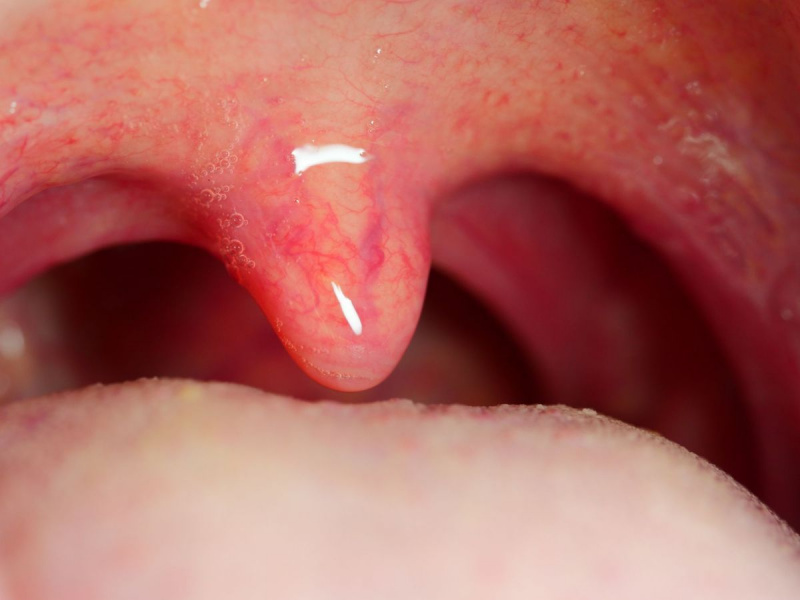 9 Alasan Anda Tidak Harus Mengabaikan Uvula yang Bengkak, Menurut Dokter