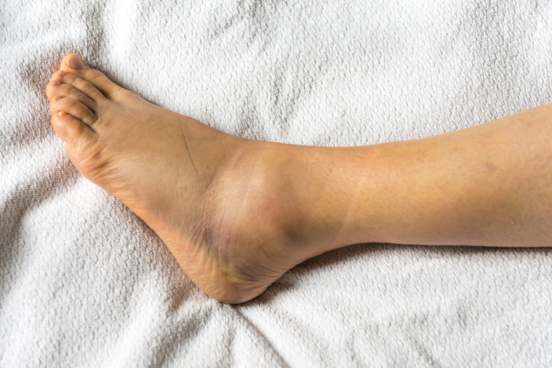 12 razões pelas quais você tem tornozelos inchados, de acordo com os médicos