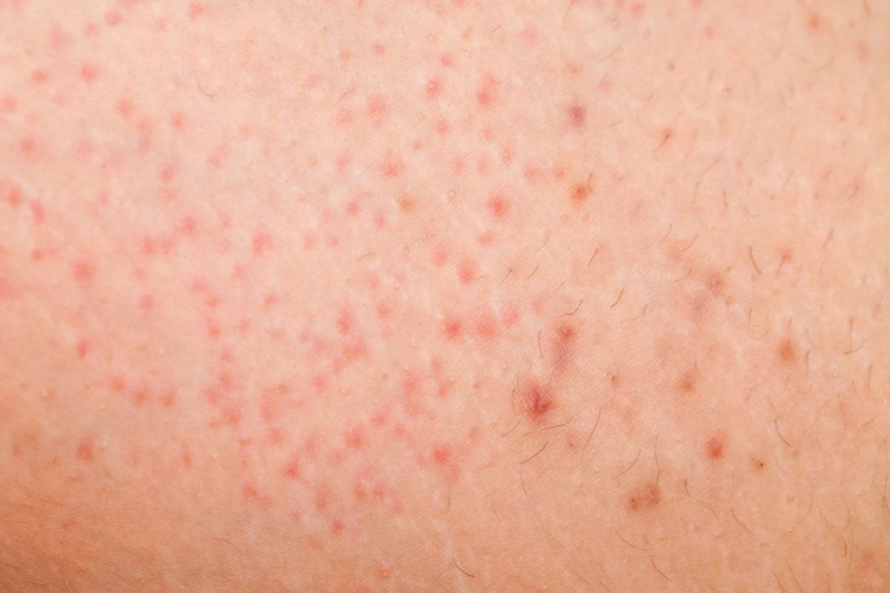 Folliculitis på kvindelig hud