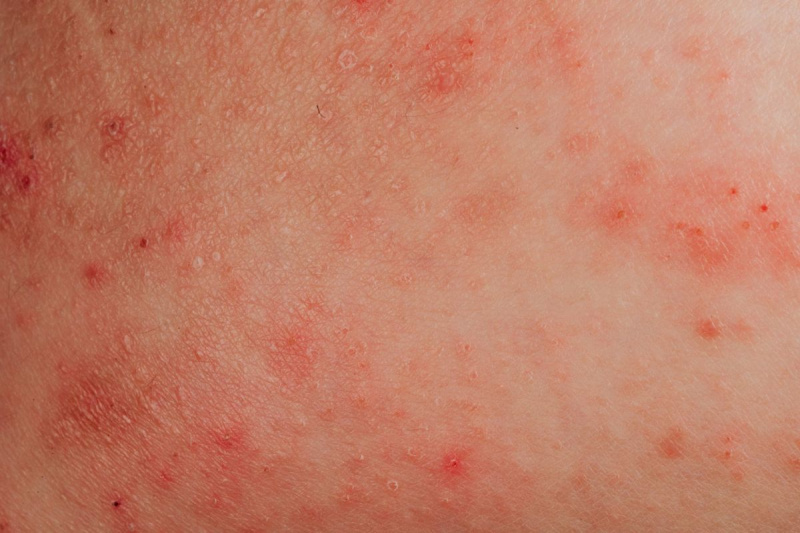 बीमार मानव त्वचा की एटोपिक एक्जिमा एलर्जी बनावट