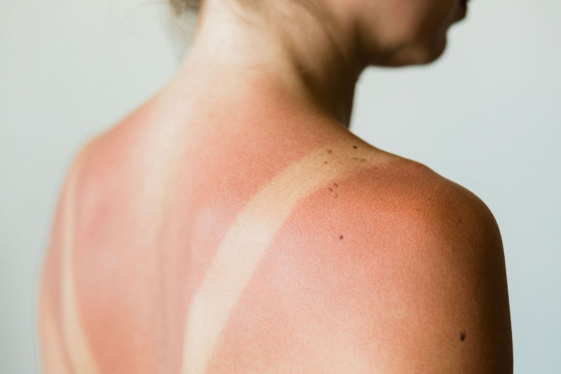 एक महिला पर सनबर्न के निशान का क्लोजअप