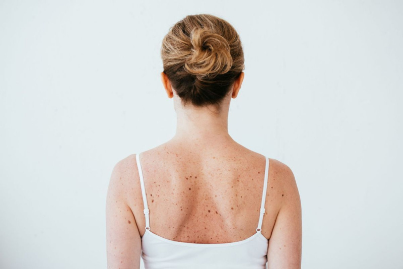 moters, sergančios melanoma, vaizdas ant nugaros ant sergančios odos, izoliuotas baltai