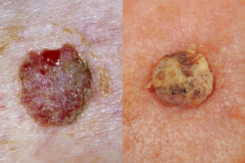 扁平上皮がん皮膚がんの写真