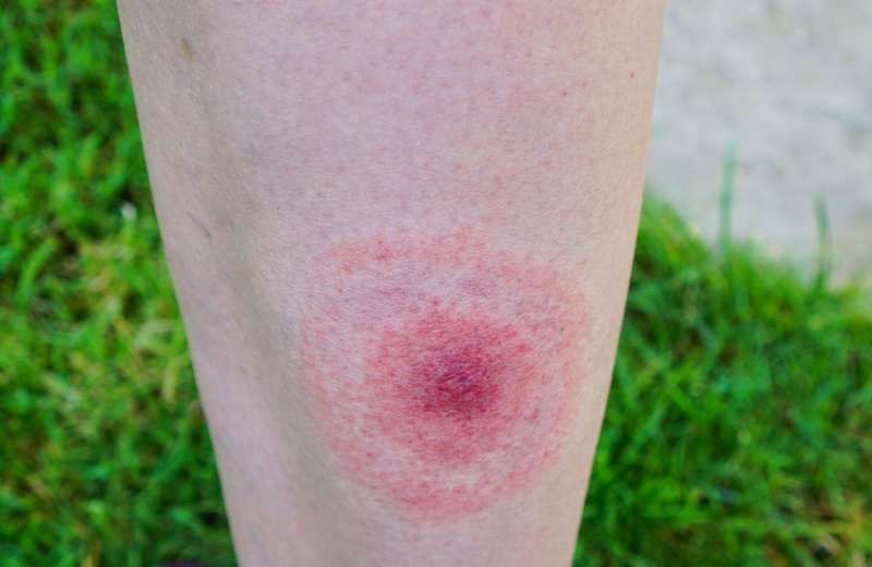 Doença de Lyme, Borreliose ou Borrelia, erupção cutânea típica, manchas.