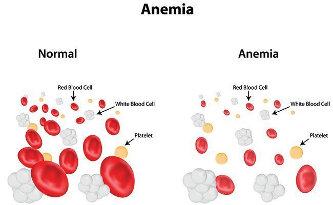 Fatos sobre anemia